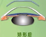 角膜塑形鏡