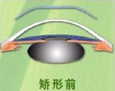 角膜塑形鏡