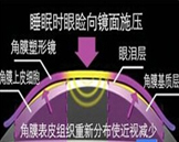 角膜塑形鏡